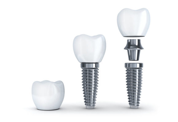 dental implants in mexico cost