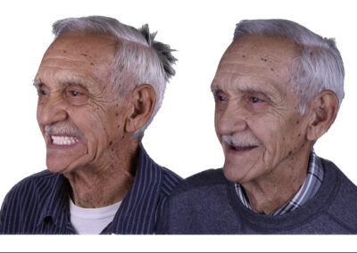 All on 4 dental implants in los algodones Desktop
