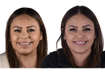 Imax Veneers in los algodones desktop