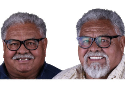 Zirconia Crowns in los algodones desktop