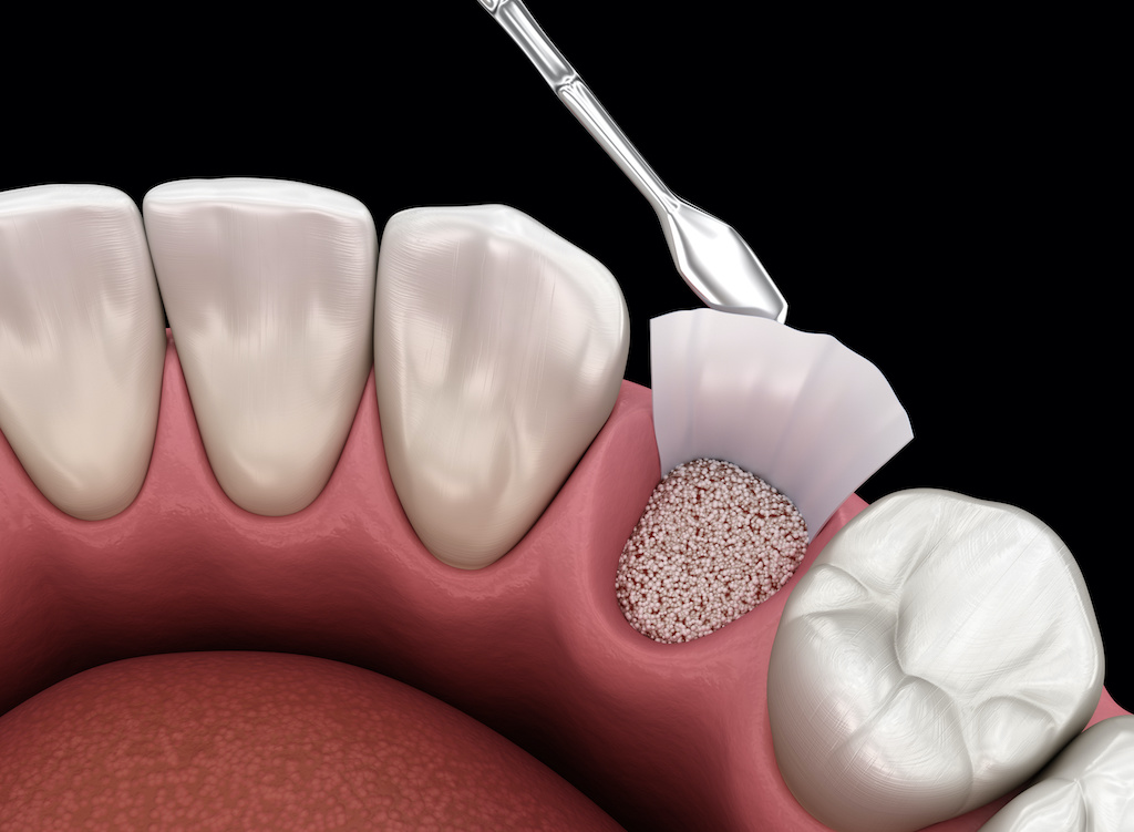 bone graft and sinus lift cost in mexico