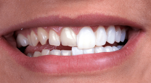 dental veneers in mexico algodones