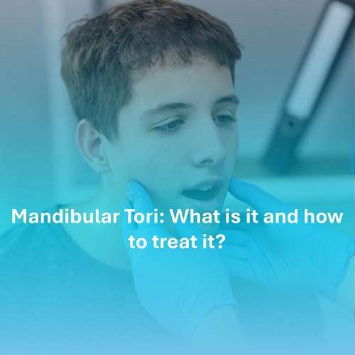 Mandibular Tori: What is it and how to treat it?